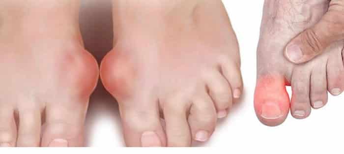 درمان بیماری نقرس با نمک دریای درمان بیماری نقرس با نمک دریای